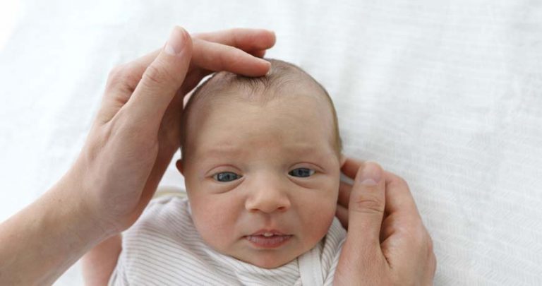 cradle-cap