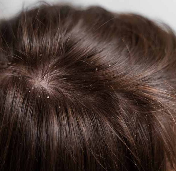 dandruff-in-toddlers
