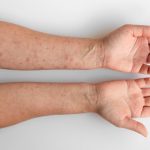 hives-in-chcildren-causes-care-tips