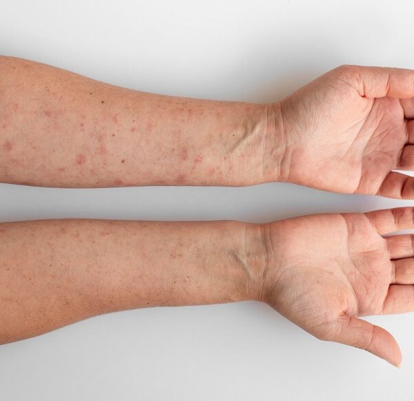 Hives in children: Causes and care tips