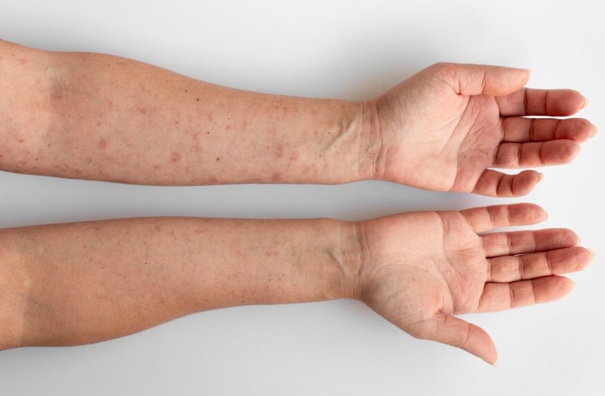 hives-in-chcildren-causes-care-tips
