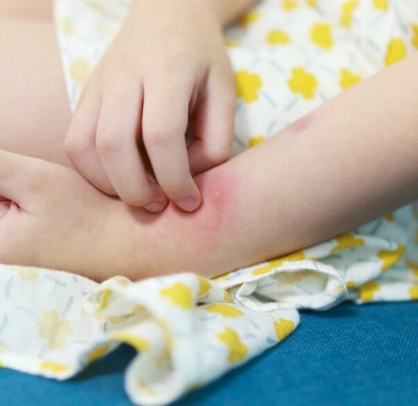 what-is-heat-rash-for-kids