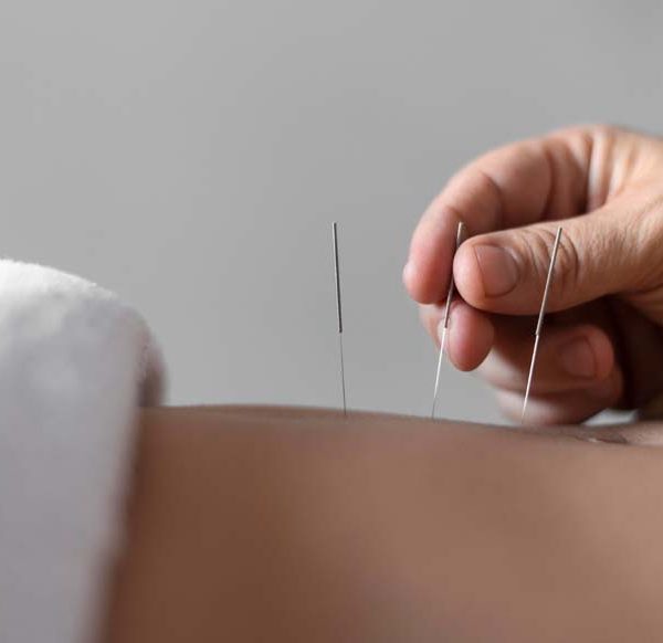 accupuncture-for-babies