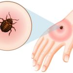 How to Deal With Bed Bug Bites on Babies