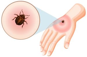 How to Deal With Bed Bug…
