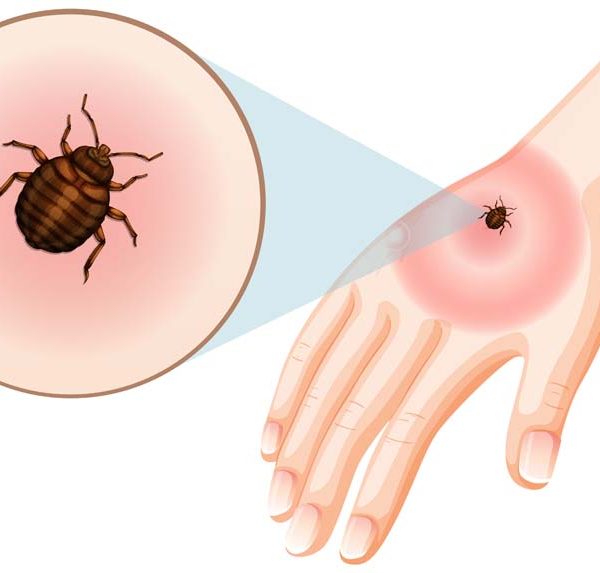 How to Deal With Bed Bug Bites on Babies