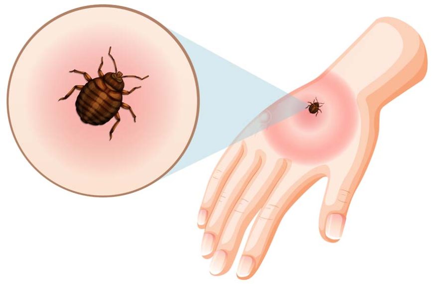 How to Deal With Bed Bug Bites on Babies