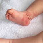 birthmarks-in-infants