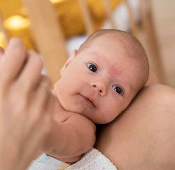 infant-acne