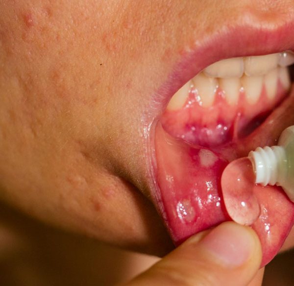 mouth-ulcers-in-babies