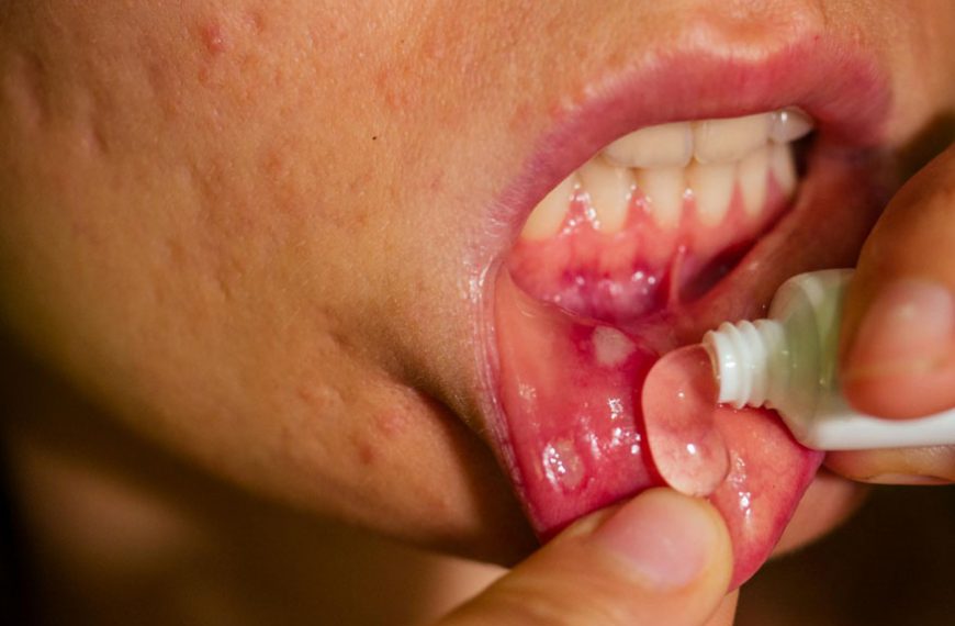 mouth-ulcers-in-babies