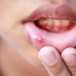 canker-sores