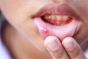 canker-sores