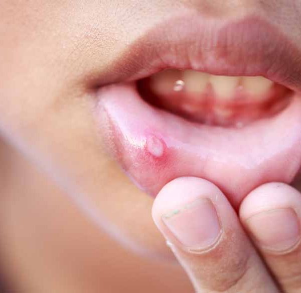 canker-sores
