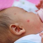 infant-eczema