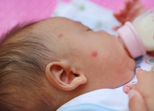 infant-eczema