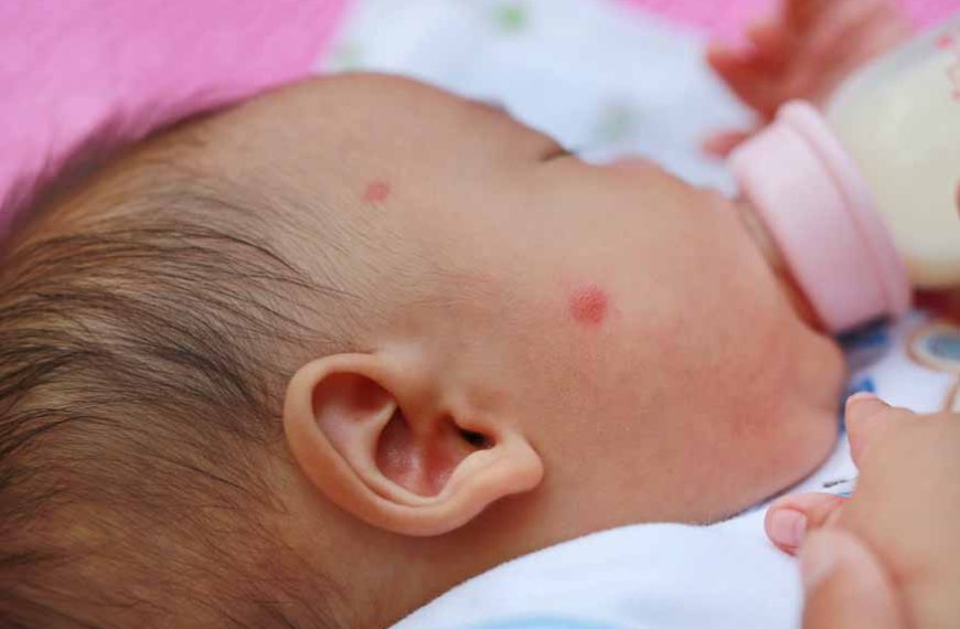 infant-eczema