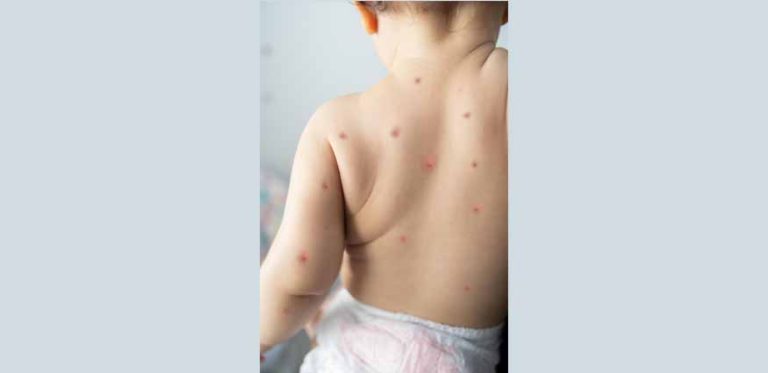 baby-rashes