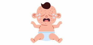 chickenpox-in-babies