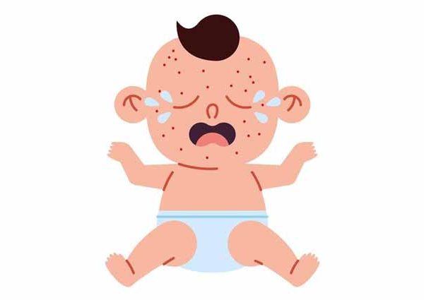 Chickenpox in Babies- Causes, Symptoms, and Prevention Tips