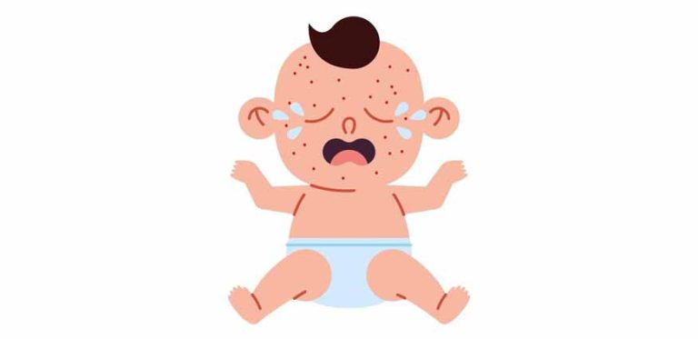 chickenpox-in-babies