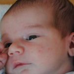 infantile-acne