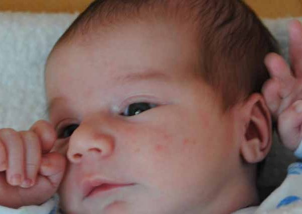 Infantile Acne: Understanding Its Origins and Effective Treatment Options