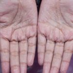 wrinkling-of-fingers-and-toes