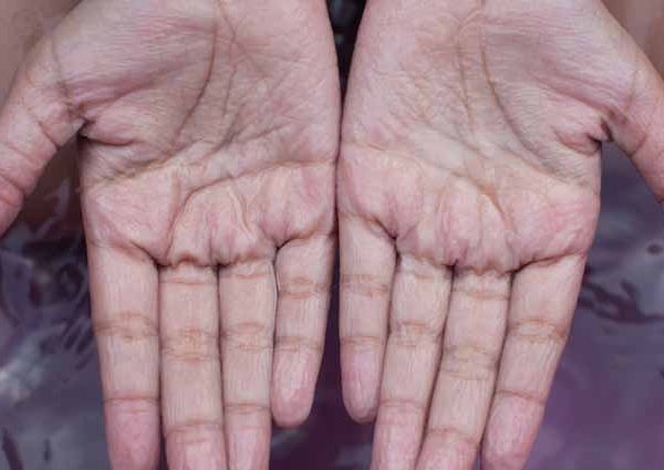 Wrinkling of Fingers and Toes: Explain to Kids
