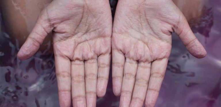 wrinkling-of-fingers-and-toes