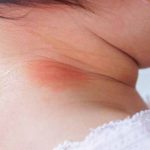 baby-neck-rash