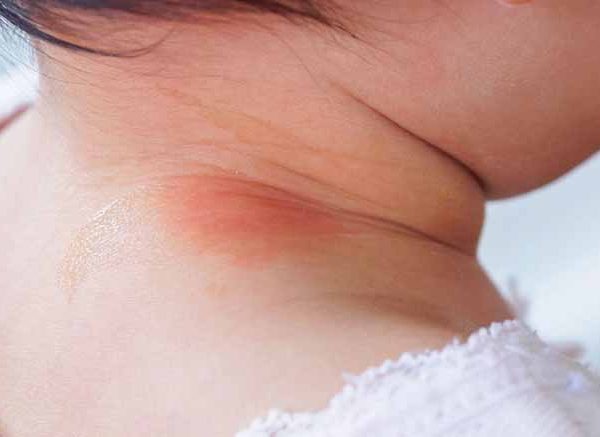 Baby Neck Rash: Causes, Symptoms, and Treatment Options
